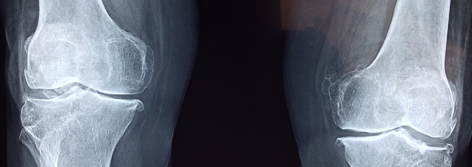 Knee X-Ray